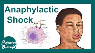 Anaphylactic shock  Anaphylactic Reaction Symptoms and Treatment [upl. by Gwenny]