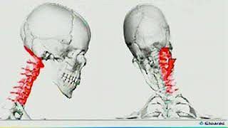 ¿Qué es la tortícolis y cómo tratarla [upl. by Tootsie170]