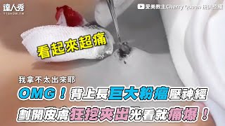 【OMG！背上長巨大粉瘤壓神經 劃開皮膚狂挖夾出光看就痛爆！】｜cherryqueen8462 [upl. by Qifar]