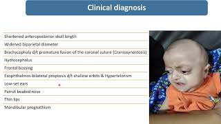 Crouzon’s Syndrome  Spot Diagnosis  4  Pediatrics [upl. by Lorsung]