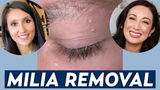 How Do You Remove Milia A Dermatologist Shares Milia Treatment amp Prevention Tips  DERM CHAT [upl. by Alexia]