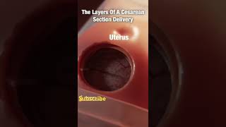 Beautiful Breech C Section Delivery 40 weeks 10day pregnancy 🤱shots [upl. by Nnaegroeg]