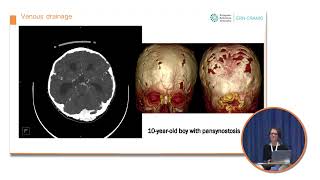 MRI evaluation in craniosynostosis [upl. by Elawalo]