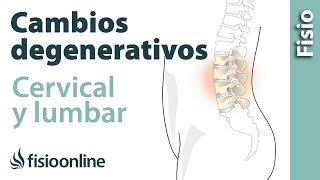 Cambios degenerativos lumbares o cervicales  ¿Qué es [upl. by Boggers712]