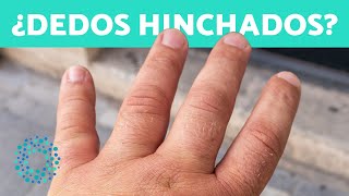 ¿Por qué se HINCHAN los DEDOS de las MANOS 10 Motivos 🖐️ ¿Cómo Desinflamar Manos Hinchadas [upl. by Liban346]