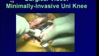 Minimally Invasive Joint Replacement [upl. by Ahsiekram]