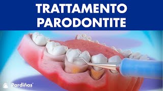 Trattamento parodontite – Curettage e sondaggio parodontale © [upl. by Horton]