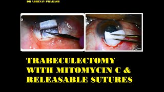 TRABECULECTOMY WITH MITOMYCIN C amp RELEASABLE SUTURES [upl. by Lurette]