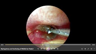 Myringotomy and Suctioning of Middle Ear Fluid In Acute Otitis Media [upl. by As]