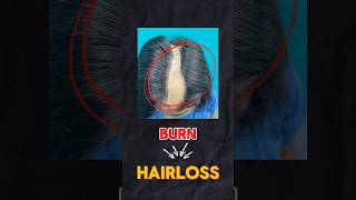 Is a hair transplant possible on the burnt area of the scalp  Explained by Dr Jangid [upl. by Elkin91]