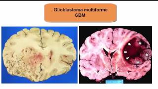 Glioblastoma Multiforme what you need to know [upl. by Lemmie185]