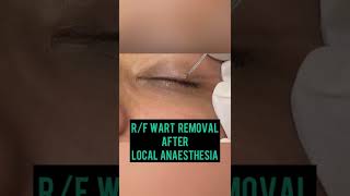 Wart removal on Eyelidhow to get rid of wartsDermatologist in Chandigarh Dr Ashima Goel Mohali [upl. by Onej]