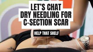 Dry Needling For CSection Scar [upl. by Ynolem941]