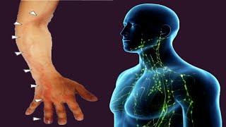 Lymphangitis Causes And Symptoms [upl. by Llenrep]