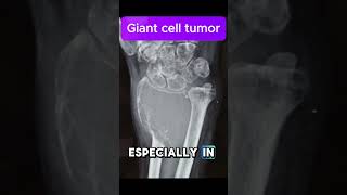 Giant cell tumor [upl. by Elliven]