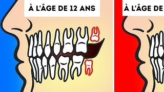 Aton Vraiment Besoin de Retirer Nos Dents de Sagesse [upl. by Sykes]