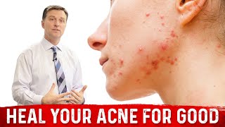 What Causes Pimples and How to Get Rid of Acne [upl. by Eintroc475]