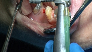 Implantes endodoncia coronas  Odontologia Multidisciplinar Dentistry Multidisciplinary [upl. by Teagan]