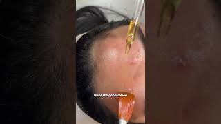 Why Should you consider Dermapen 4 Treatment  Dr Sarin [upl. by Ardnuahs]