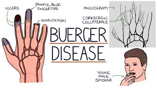 Understanding Buerger Disease Thromboangiitis Obliterans [upl. by Zenia774]