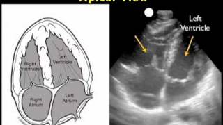 How to Cardiac Ultrasound  Apical View Case Study [upl. by Loomis527]