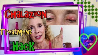 Chalazion Treatment Hack [upl. by Atteirneh]