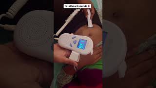 Fetal heart sounds using Doppler⭐️ [upl. by Suhpoelc390]