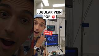 Jugular vein under valsalva [upl. by Eta]