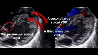 10 Tips to be a Better Pediatric Echocardiographer 🥇❗ [upl. by Eliam]