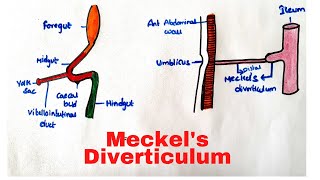 Meckels Diverticulum [upl. by Pinckney713]