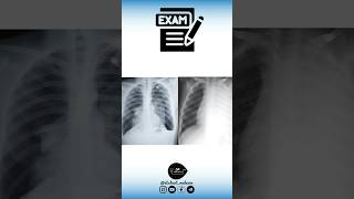 Epanchement pleural VS Pneumothorax  Exam [upl. by Prudhoe483]