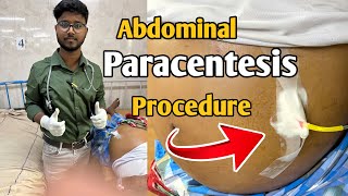 How I do abdominal paracentesis easily during internship after passing FMGE  Abdominal Tap [upl. by Avi]