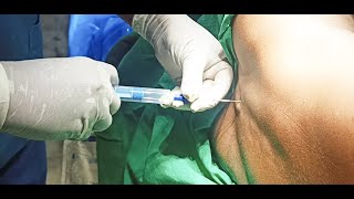 Epidural Anaesthesia  2  techniques  DrSParthasarathy MDDNB PhD [upl. by Enieledam]