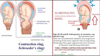 Obstetrics Contraction Constriction Ring Obstruction Pathological Retraction Ring Bandl difference [upl. by Dierolf]