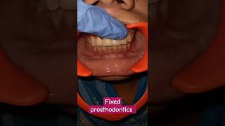 Fixed prosthodontics dentalcafe4331 [upl. by Nytsirc]