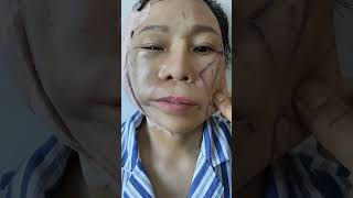 一邊做了，一邊沒做，對比明顯嗎？ medical plasticandbeauty plastic beautiful trending viralvideo fyp explore [upl. by Ahsekyt345]