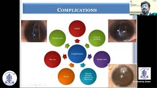 Vernal Keratoconjunctivitis  Prof Rajesh Sinha [upl. by Haldi426]