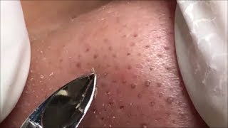 角栓 除去 blackheads removal 111 [upl. by Ilhsa]