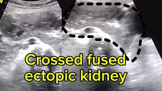 How to identify crossed fused ectopic kidney in ultrasound [upl. by Kcinimod]