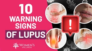 10 Vital Warning Signs of Lupus [upl. by Yttocs525]