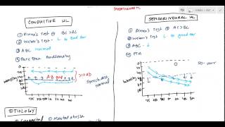 Conductive and Sensorineural Hearing Loss Deafness for USMLE [upl. by Eilyab]