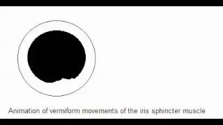 Vermiform movement of the iris spincter muscle  Adies Pupil [upl. by Agon]