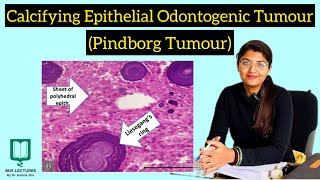 Calcifying Epithelial Odontogenic Tumour  Pindborg Tumour  CEOT  Lecture  21  Oral Pathology [upl. by Atelokin]