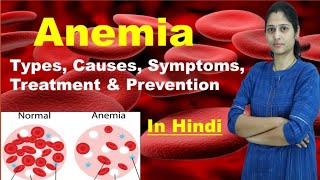 Anemia  Types of Anemia  Causes Symptoms Treatment Prevention Risk Factors  In Hindi [upl. by Stortz]