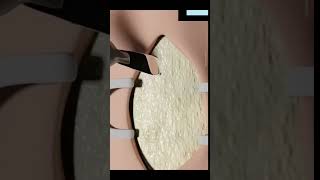 Tracheostomy procedure explained facts 3danimationfact funfacts [upl. by Blanchard]