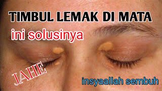 mengatasi lemak di kelopak mata xanthelasmapijatxanthelasma [upl. by Voccola217]