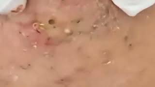 Punti Neri Acne Blackheads Removal pt1 [upl. by Nyhagen841]