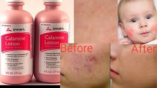 Calamine Lotion 🥰 [upl. by Alexei]