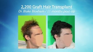 Hair Transplant Result 2200 Grafts Feller and BloxhamGreat Neck Long Island NY [upl. by Haeluj]