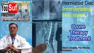 Disc Herniated  Intervertebral Disc Space Treatment  Ozone Injection  Dr Yousuf Memon Case8809 [upl. by Flss]